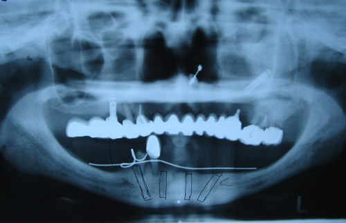 图片右侧，可见落入上颌窦的牙植体