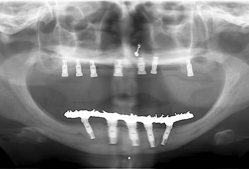 上牙经过植骨，完成种植牙手术的牙植体植入