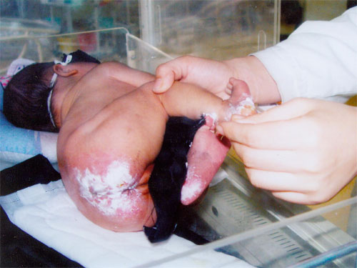 七天女婴为何被烫伤 女婴父母医院举牌讨说法